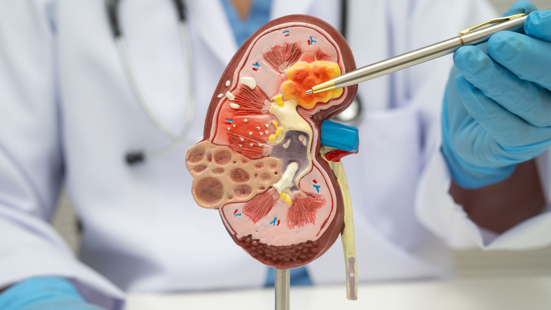 Cáncer de riñón: Factores de riesgo y cómo prevenirlo