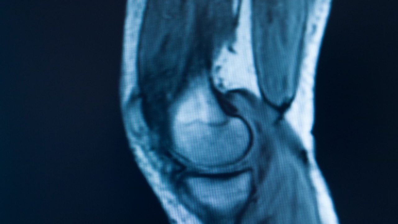 ¿Te indicaron una resonancia de rodilla? Esto debes saber