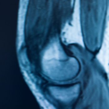¿Te indicaron una resonancia de rodilla? Esto debes saber